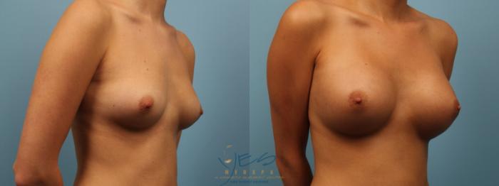 Before & After Breast Augmentation Case 153 View #2 View in Vancouver, BC