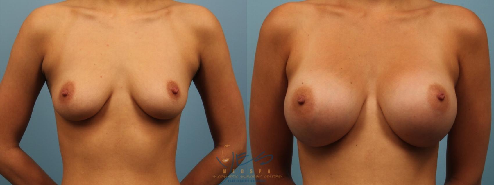 Breast Augmentation Case 154 Before & After Front | Vancouver, BC | YES Medspa & Cosmetic Surgery Centre