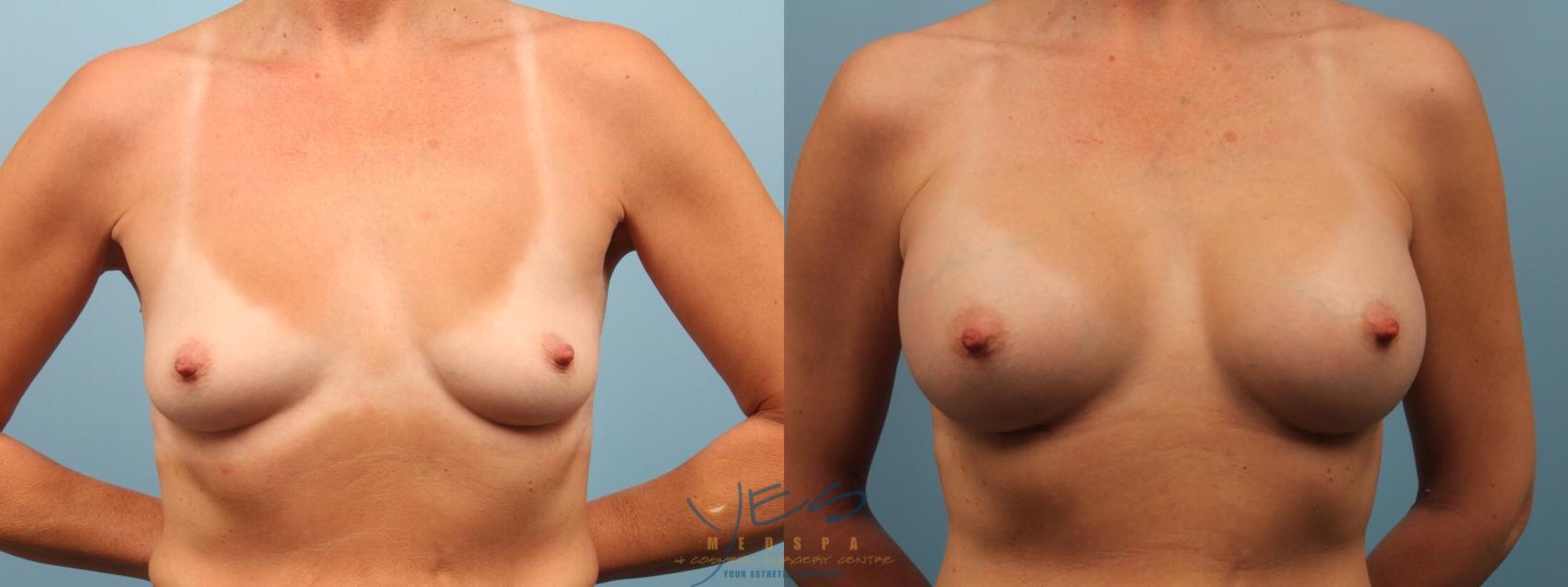 Before & After Breast Augmentation Case 166 View #1 View in Vancouver, BC