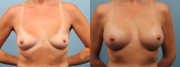 Before & After Breast Augmentation Case 166 View #1 View in Vancouver, BC