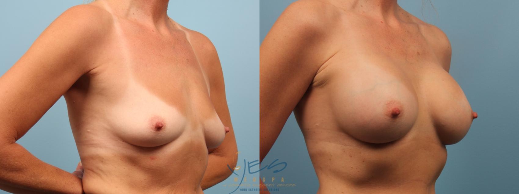 Before & After Breast Augmentation Case 166 View #2 View in Vancouver, BC