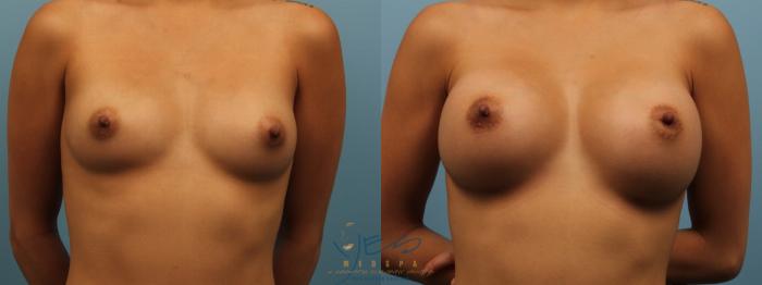 Before & After Breast Augmentation Case 167 View #1 View in Vancouver, BC