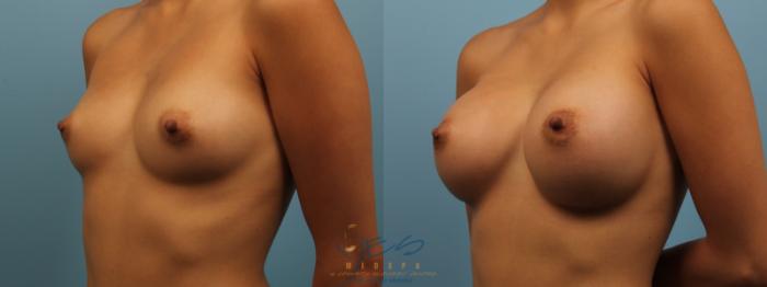Before & After Breast Augmentation Case 167 View #2 View in Vancouver, BC