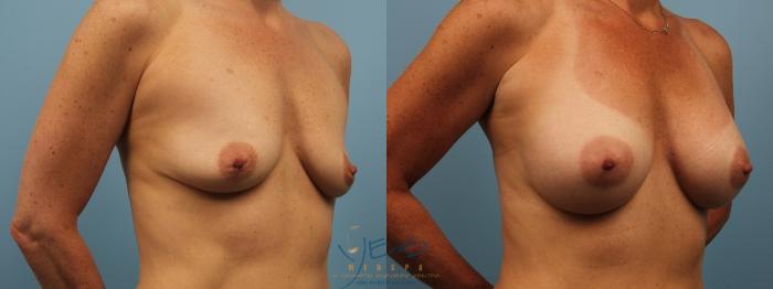 Before & After Breast Augmentation Case 177 View #2 View in Vancouver, BC
