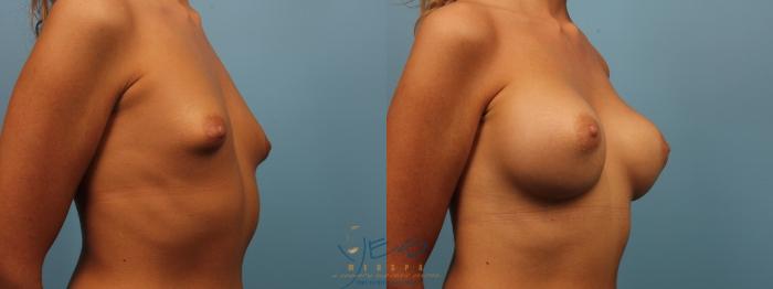 Before & After Breast Augmentation Case 180 View #2 View in Vancouver, BC