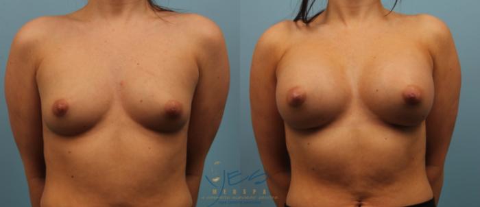 Before & After Breast Augmentation Case 184 View #1 View in Vancouver, BC