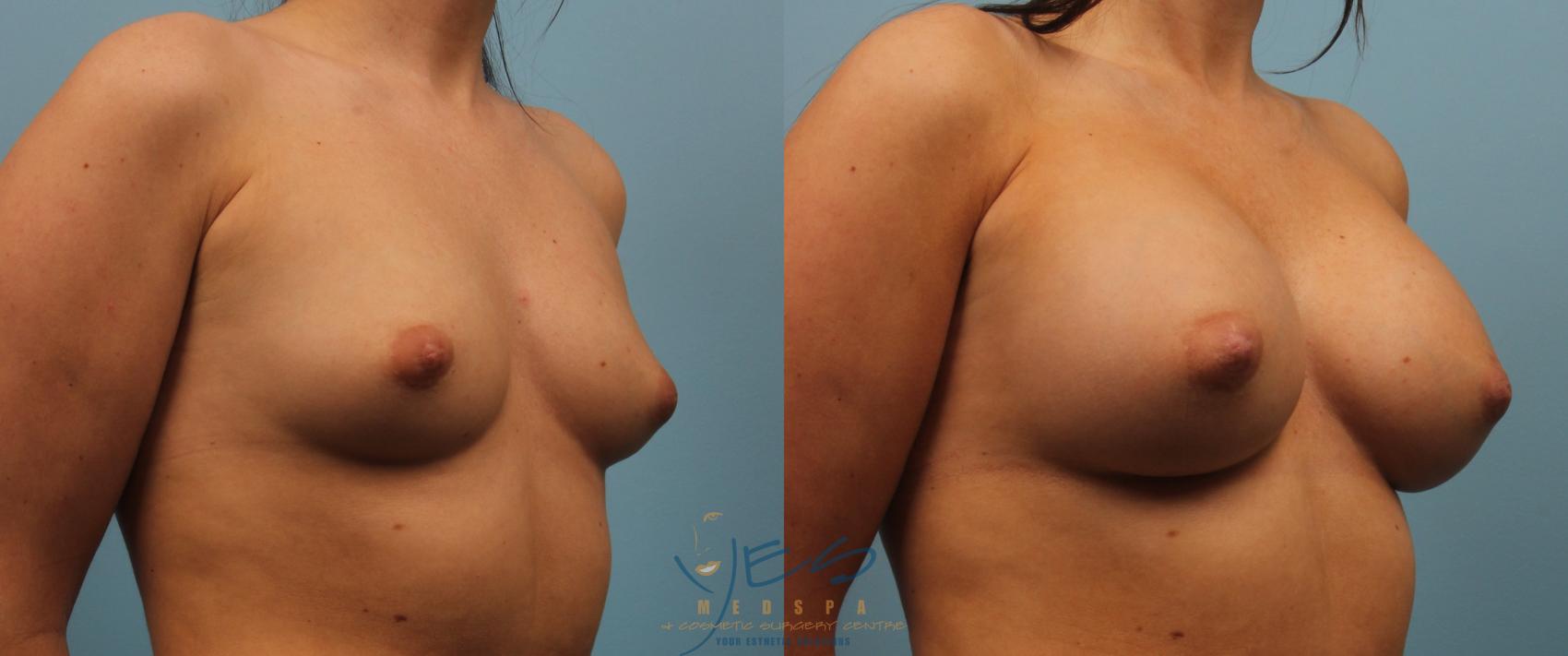 Before & After Breast Augmentation Case 184 View #2 View in Vancouver, BC