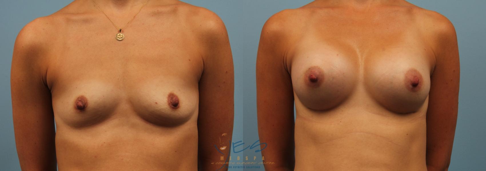 Before & After Breast Augmentation Case 185 Front View in Vancouver, BC