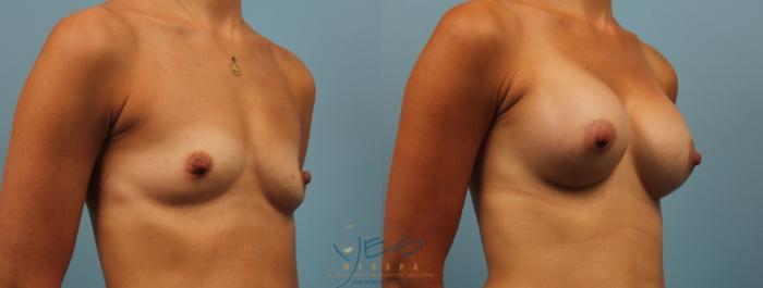 Before & After Breast Augmentation Case 185 View #3 View in Vancouver, BC
