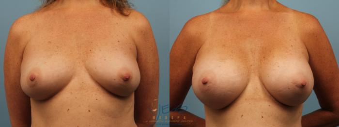 Before & After Breast Augmentation Case 191 View #1 View in Vancouver, BC