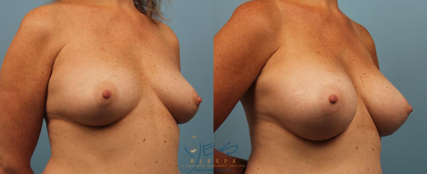 Before & After Breast Augmentation Case 191 View #2 View in Vancouver, BC