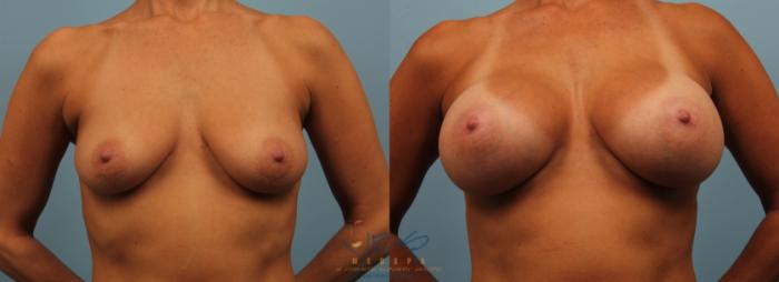 Before & After Breast Augmentation Case 192 View #1 View in Vancouver, BC