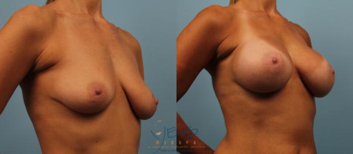 Before & After Breast Augmentation Case 192 View #2 View in Vancouver, BC