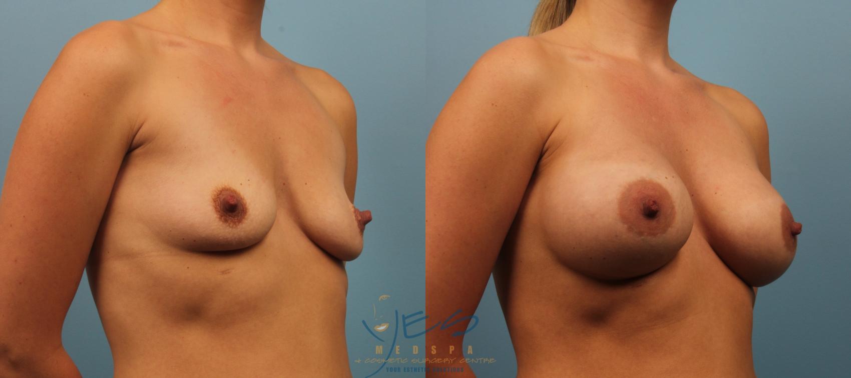 Before & After Breast Augmentation Case 193 View #2 View in Vancouver, BC
