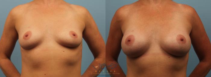 Before & After Breast Augmentation Case 194 View #1 View in Vancouver, BC