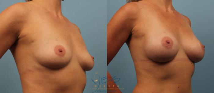 Before & After Breast Augmentation Case 194 View #2 View in Vancouver, BC