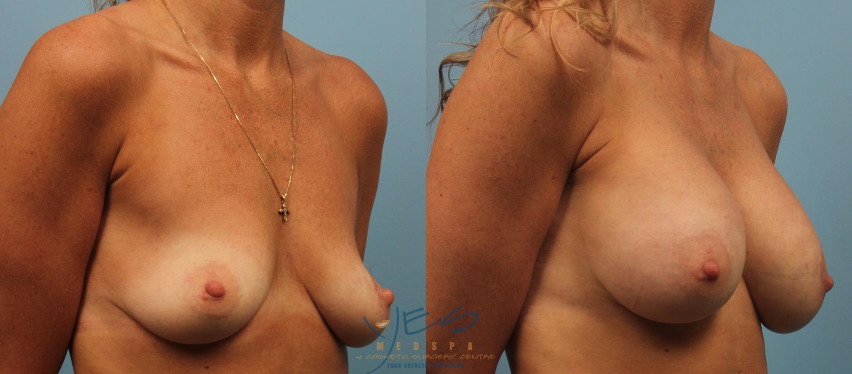 Before & After Breast Augmentation Case 195 View #2 View in Vancouver, BC