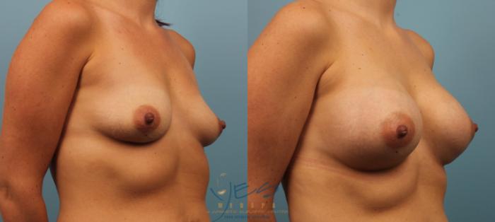 Before & After Breast Augmentation Case 196 View #2 View in Vancouver, BC