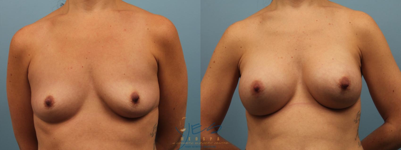 Before & After Breast Augmentation Case 197 View #1 View in Vancouver, BC