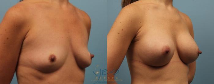 Before & After Breast Augmentation Case 197 View #2 View in Vancouver, BC