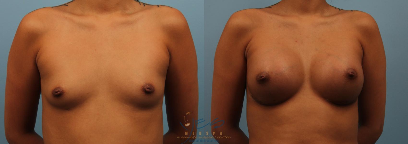 Before & After Breast Augmentation Case 198 View #1 View in Vancouver, BC