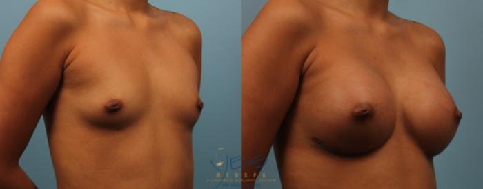 Before & After Breast Augmentation Case 198 View #2 View in Vancouver, BC