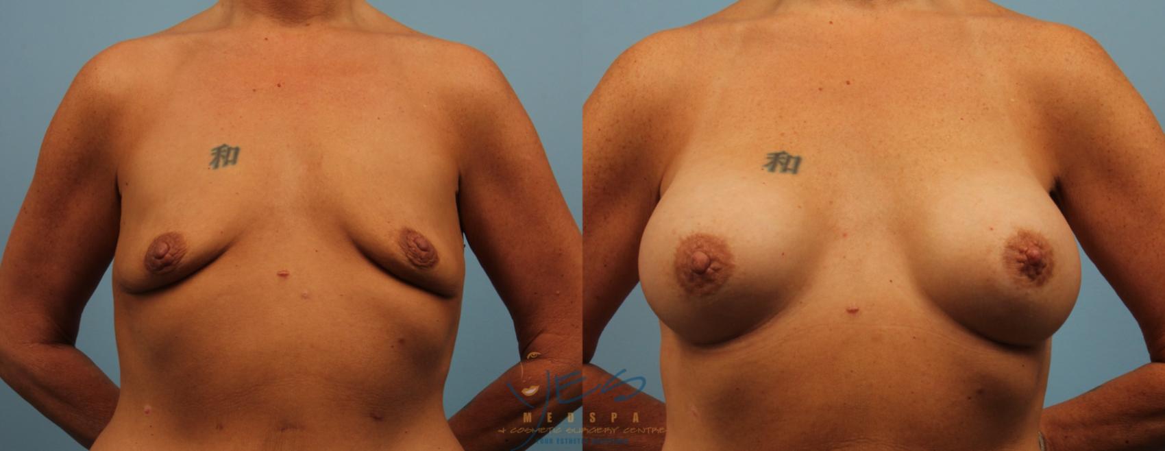 Before & After Breast Augmentation Case 199 View #1 View in Vancouver, BC