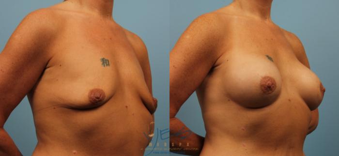 Before & After Breast Augmentation Case 199 View #2 View in Vancouver, BC