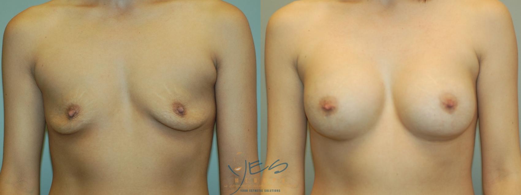 Before & After Breast Augmentation Case 2 Front View in Vancouver, BC
