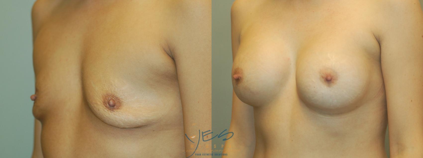 Before & After Breast Augmentation Case 2 Left Oblique View in Vancouver, BC