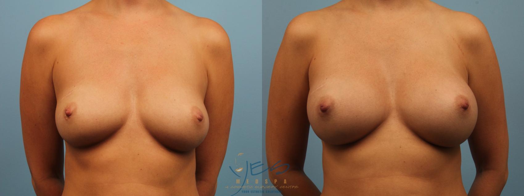Before & After Breast Augmentation Case 203 View #1 View in Vancouver, BC