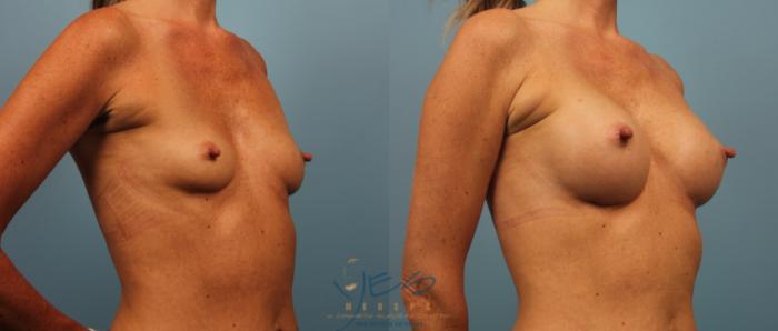 Before & After Breast Augmentation Case 229 View #2 View in Vancouver, BC