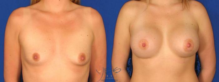 Before & After Breast Augmentation Case 23 Front View in Vancouver, BC