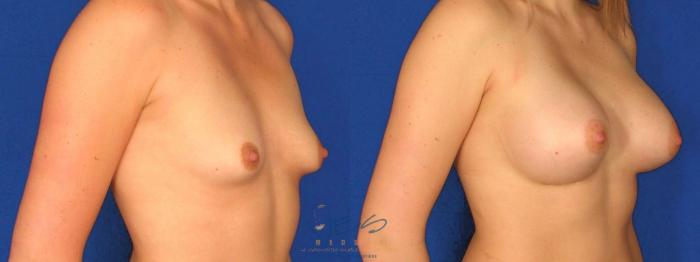 Before & After Breast Augmentation Case 23 Right Oblique View in Vancouver, BC