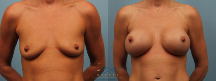 Before & After Breast Augmentation Case 235 Front View in Vancouver, BC