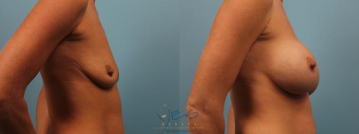 Before & After Breast Augmentation Case 235 Right Side View in Vancouver, BC