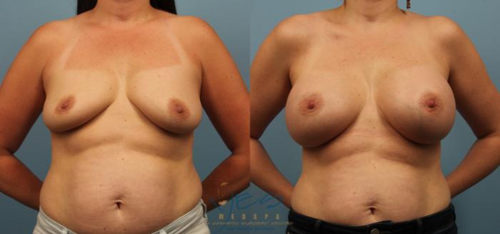 Before & After Breast Augmentation Case 236 View #1 View in Vancouver, BC