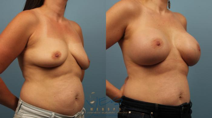 Before & After Breast Augmentation Case 236 View #2 View in Vancouver, BC