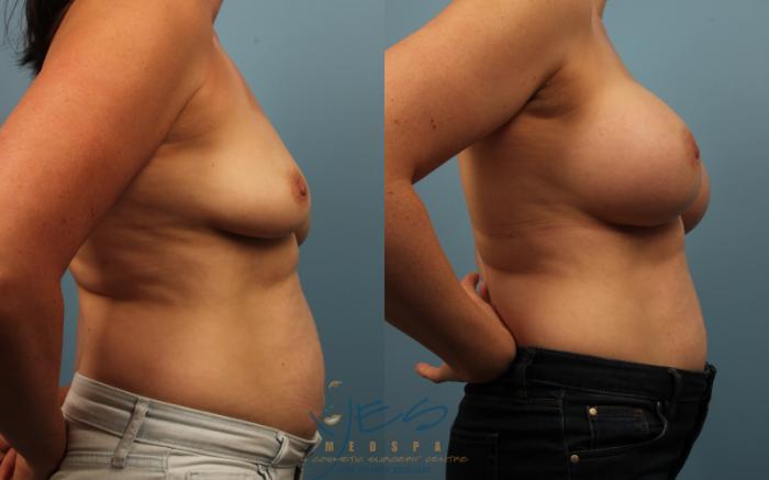 Before & After Breast Augmentation Case 236 View #3 View in Vancouver, BC
