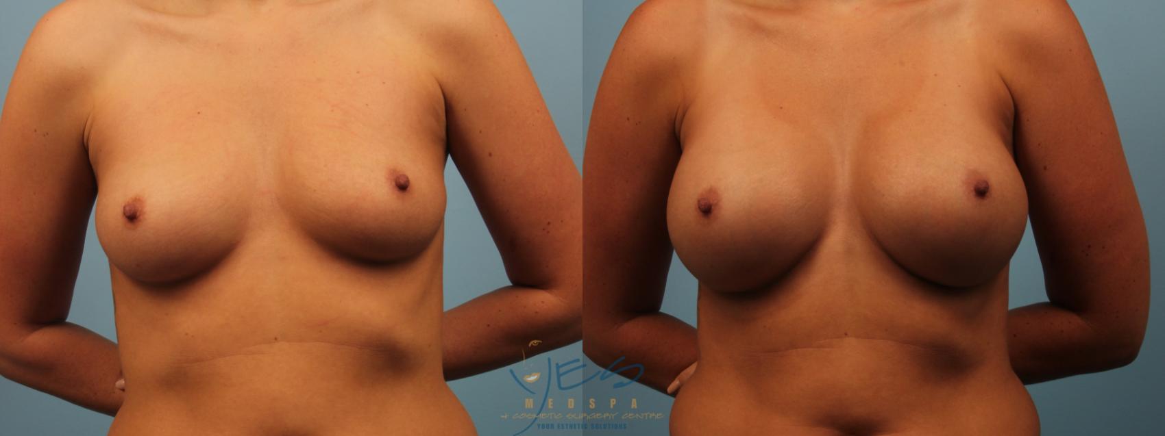 Before & After Breast Augmentation Case 244 Front View in Vancouver, BC