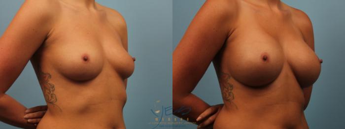 Before & After Breast Augmentation Case 244 Right Oblique View in Vancouver, BC