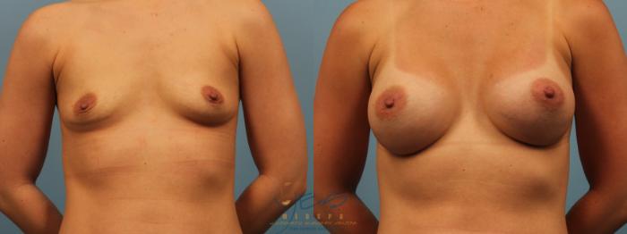 Before & After Breast Augmentation Case 246 Front View in Vancouver, BC