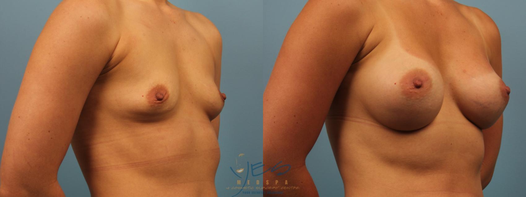 Before & After Breast Augmentation Case 246 Right Oblique View in Vancouver, BC