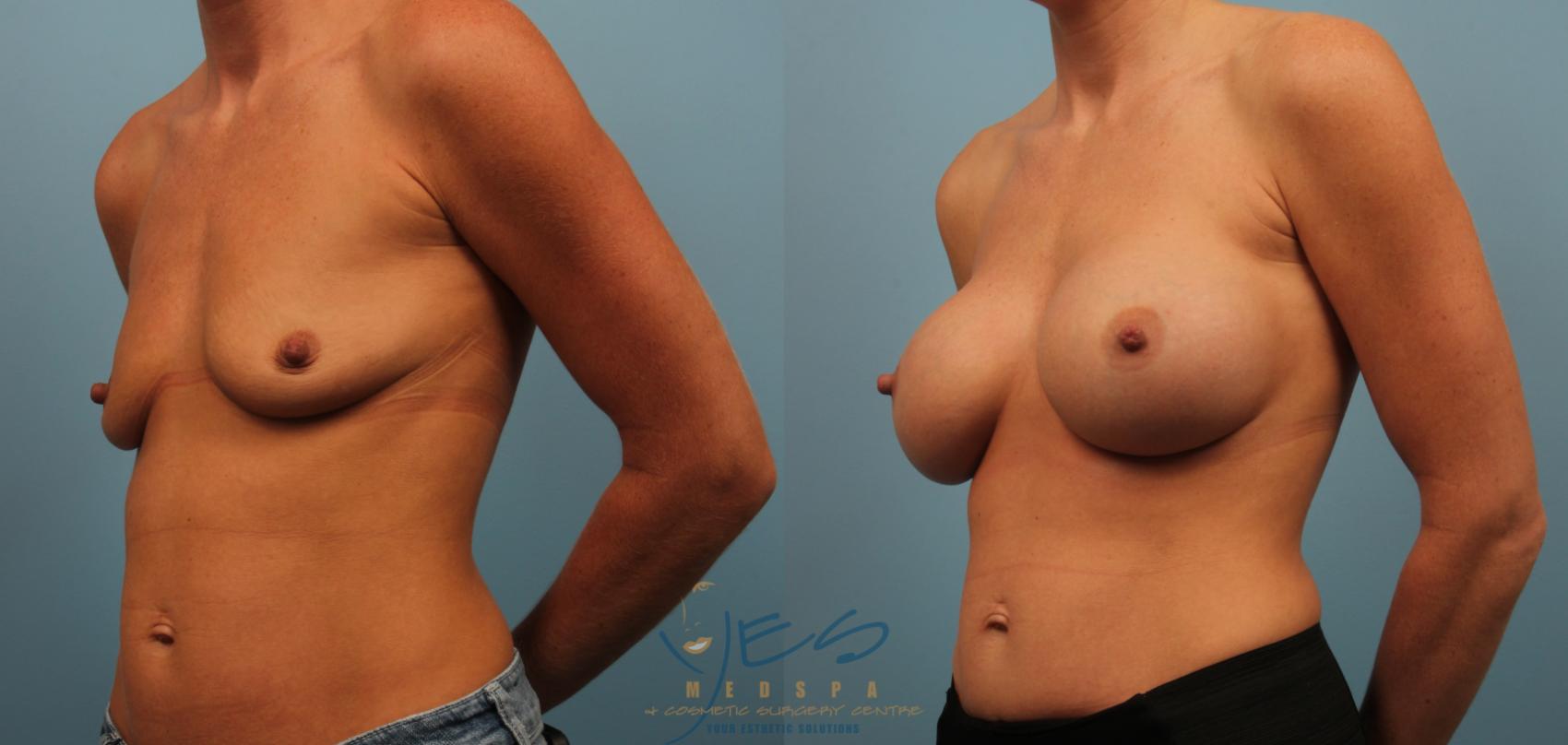 Before & After Breast Augmentation Case 247 View #1 View in Vancouver, BC
