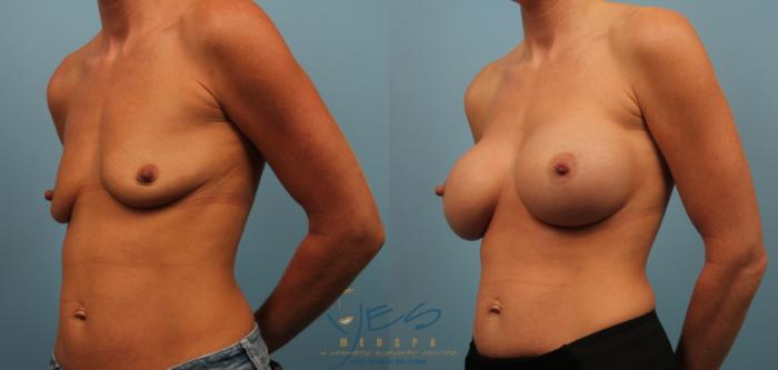Before & After Breast Augmentation Case 247 View #1 View in Vancouver, BC