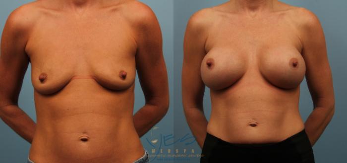 Before & After Breast Augmentation Case 247 View #2 View in Vancouver, BC