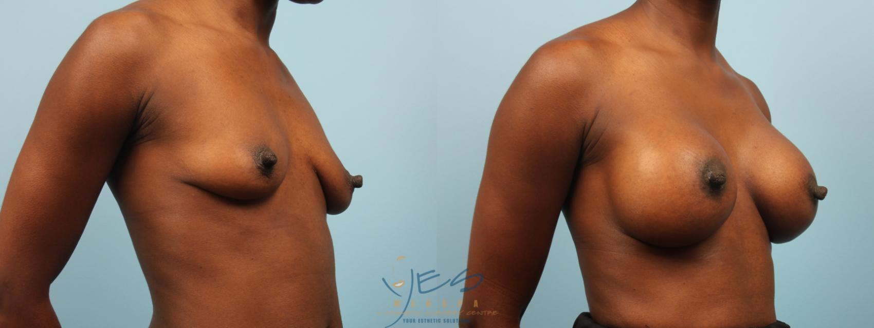 Before & After Breast Augmentation Case 249 View #1 View in Vancouver, BC