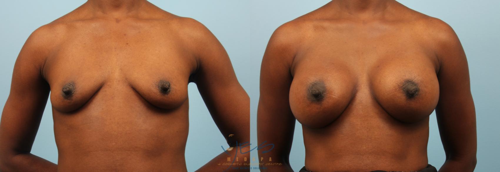 Before & After Breast Augmentation Case 249 View #2 View in Vancouver, BC