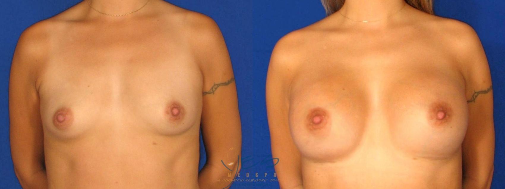 Before & After Breast Augmentation Case 25 Front View in Vancouver, BC