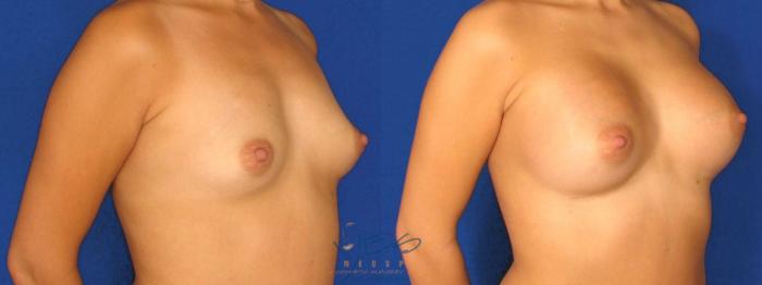 Before & After Breast Augmentation Case 25 Right Oblique View in Vancouver, BC